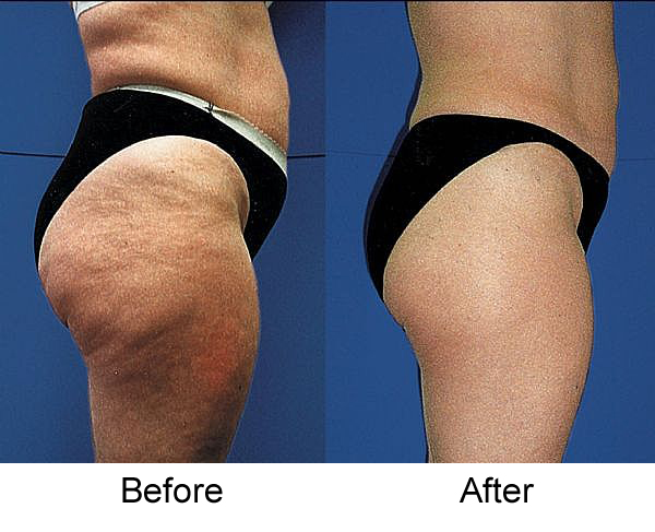 cellulite before and after
